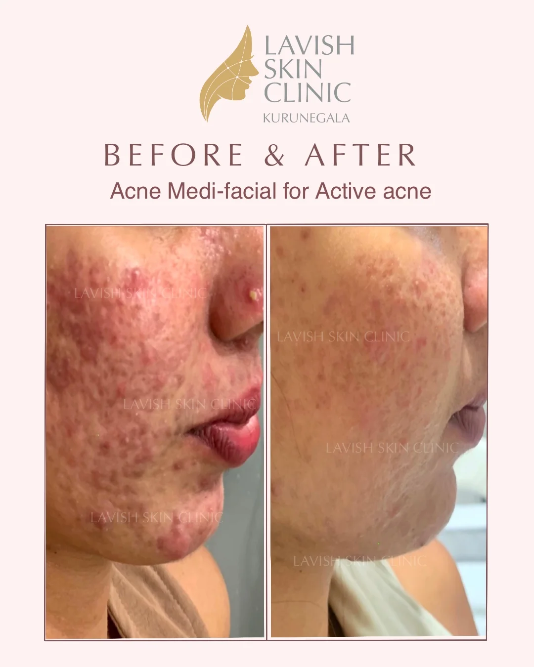 Active Acne & Cystic Acne acne & scars care at Lavish Skin Clinic in Kurunegala