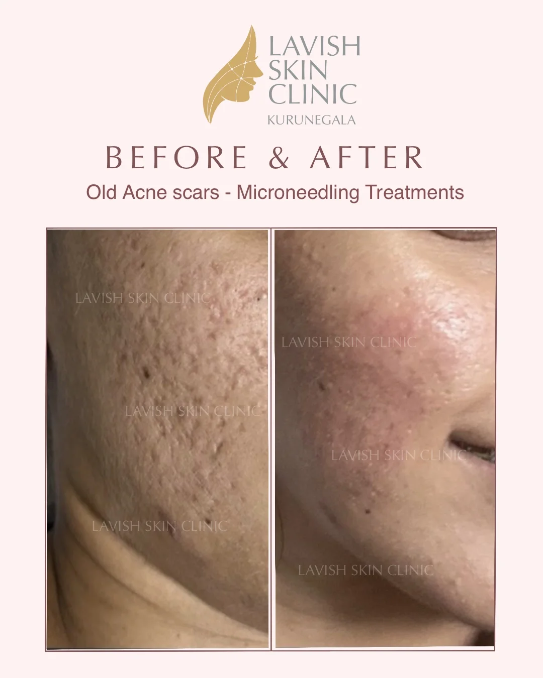 Acne Scars & Uneven Texture acne & scars care at Lavish Skin Clinic in Kurunegala