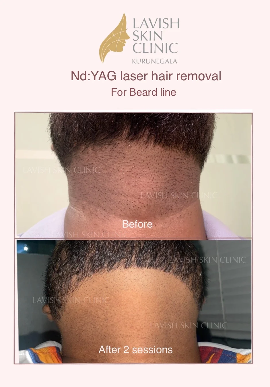 Beard Line Shaping & Ear Hair Removal laser hair removal care at Lavish Skin Clinic in Kurunegala