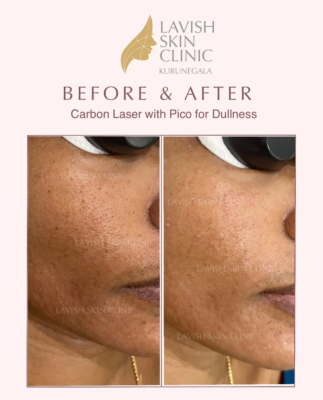 Skin Brightening Treatments pigmentation & brightening care at Lavish Skin Clinic in Kurunegala