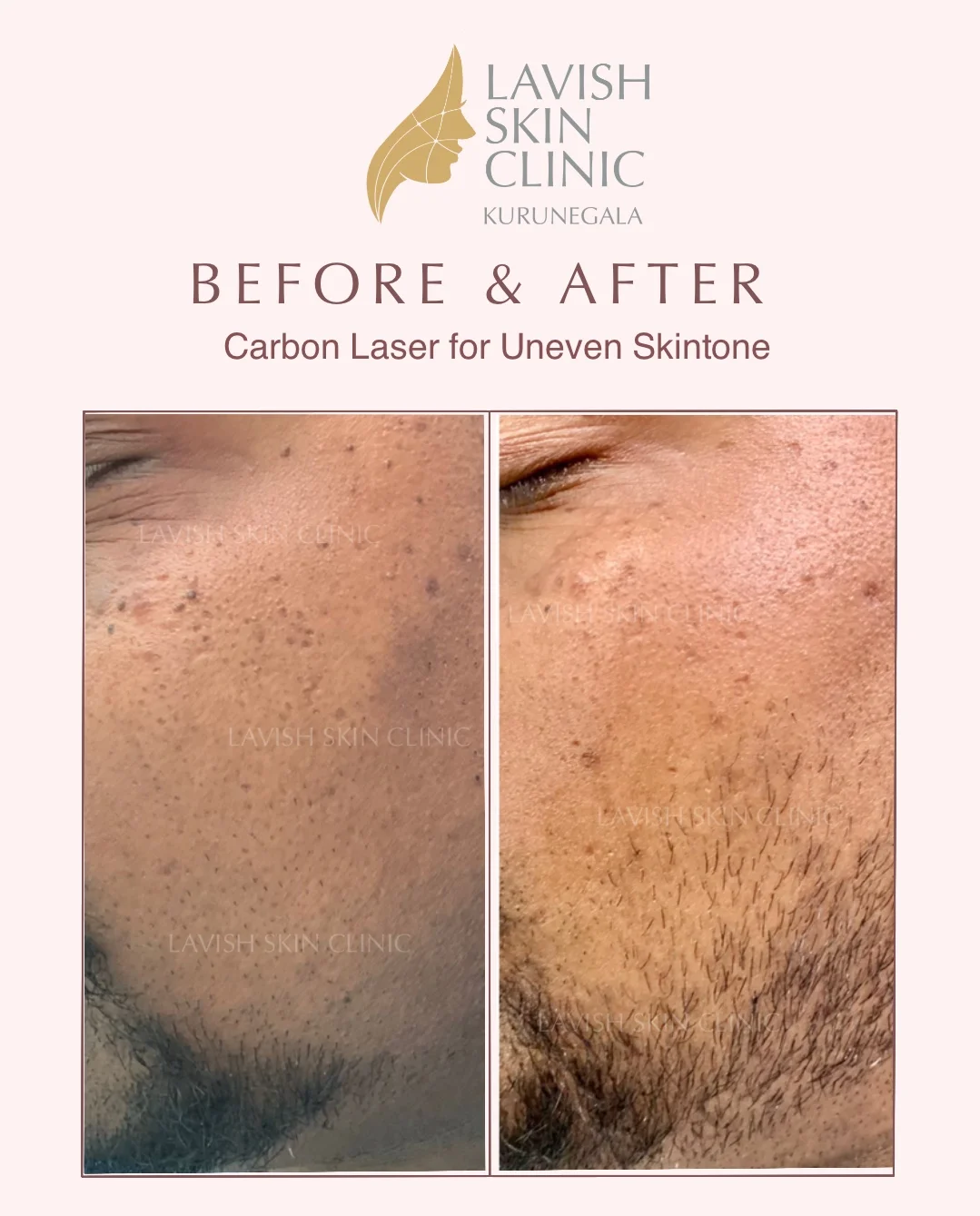 Body Hyperpigmentation & Sensitive Areas body, scars & removal care at Lavish Skin Clinic in Kurunegala
