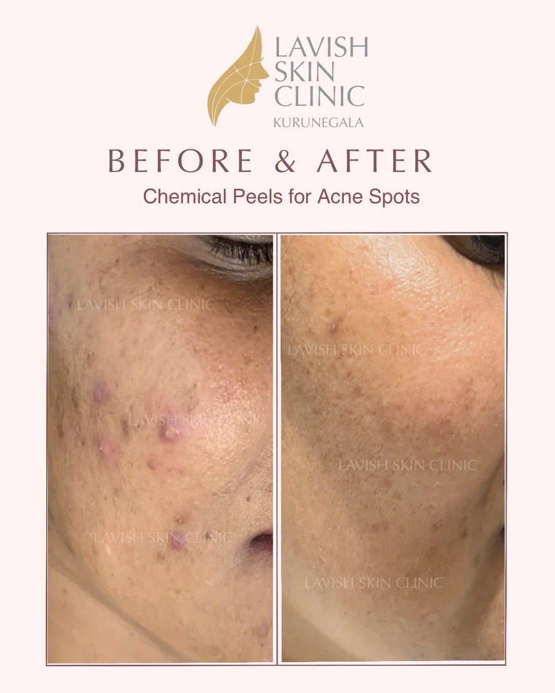 Chemical Peels & Acne Peels acne & scars care at Lavish Skin Clinic in Kurunegala