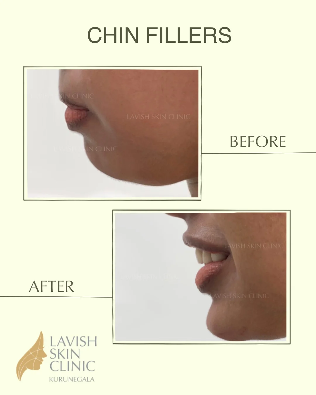 Jawline Contouring, HIFU & Fat Dissolving injectables & contouring care at Lavish Skin Clinic in Kurunegala
