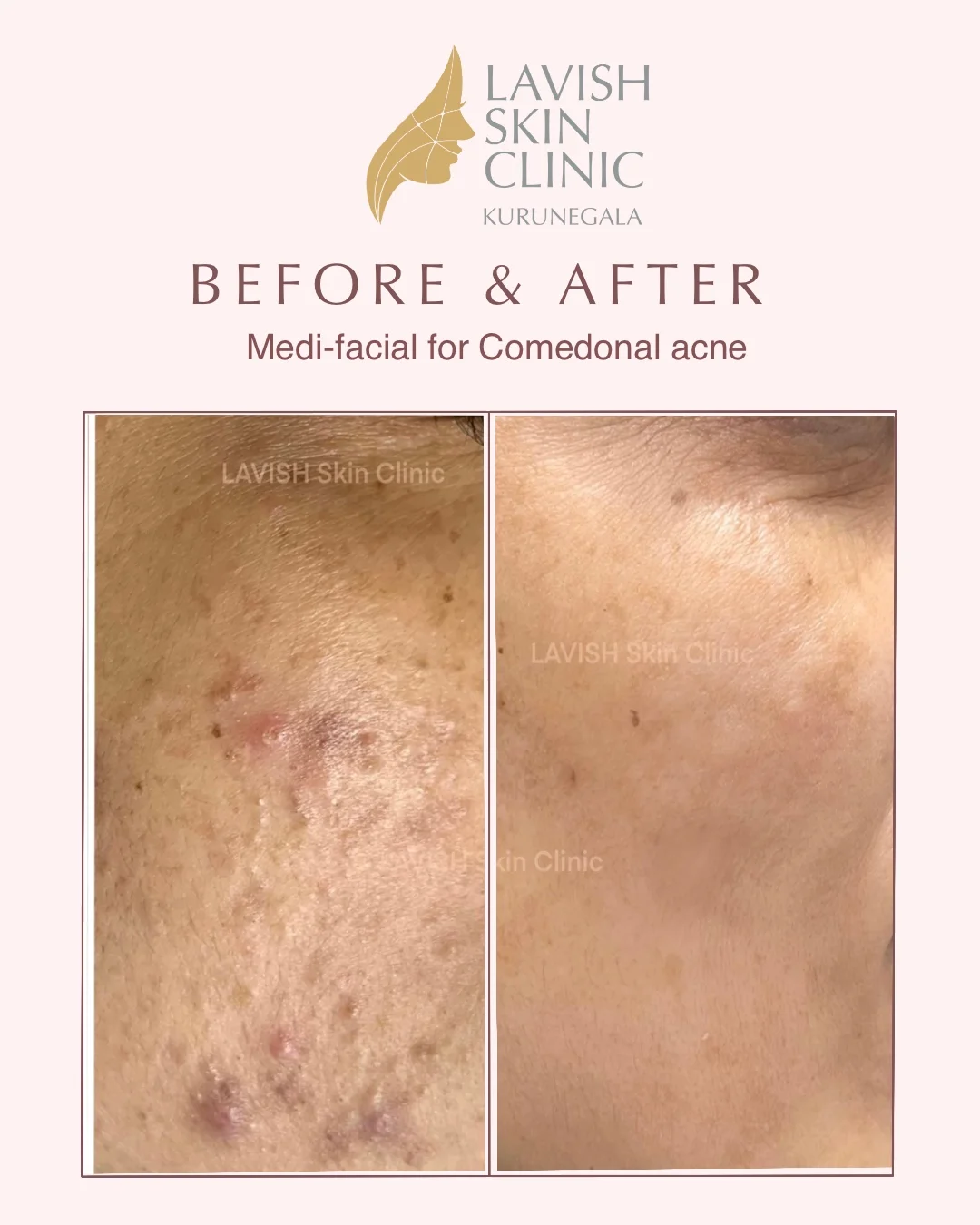 Comedonal Acne Medi-Facial medi-facials care at Lavish Skin Clinic in Kurunegala