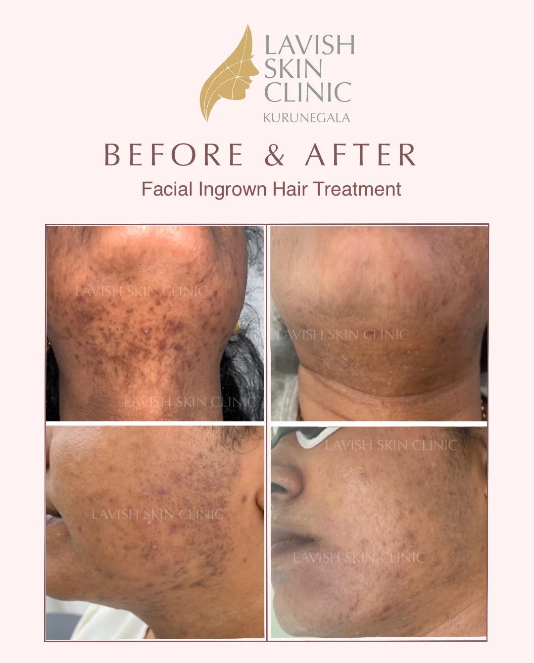 PCOS / Hirsutism Hair Concerns laser hair removal care at Lavish Skin Clinic in Kurunegala