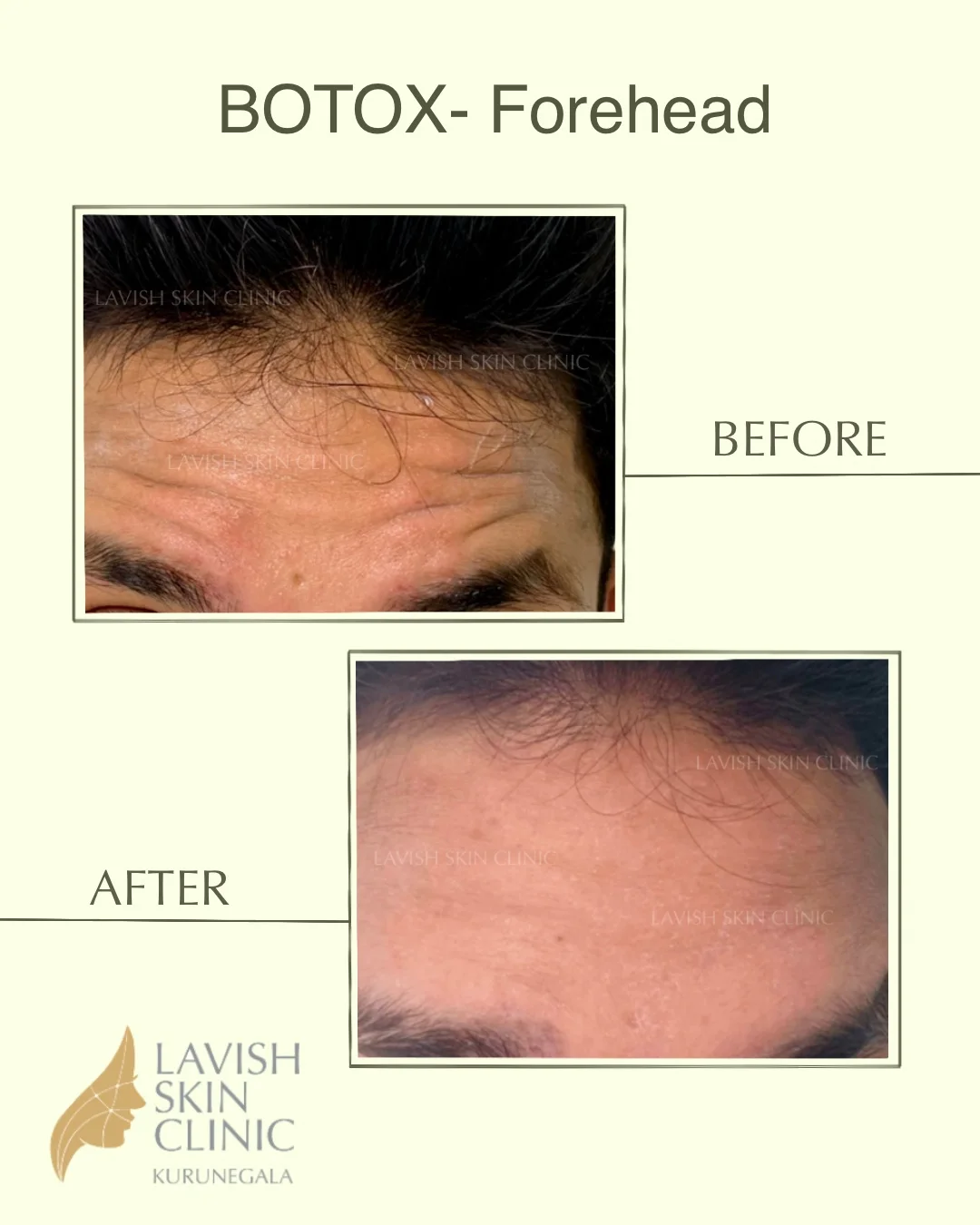 Botox For Lines & Smile Concerns injectables & contouring care at Lavish Skin Clinic in Kurunegala