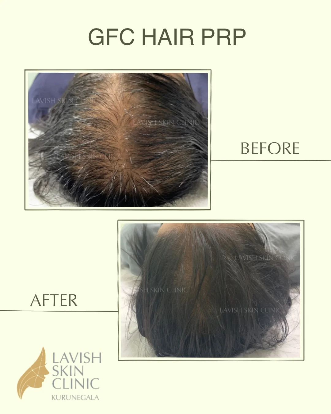 PRP, GFC & Exosome Hair Support hair restoration care at Lavish Skin Clinic in Kurunegala