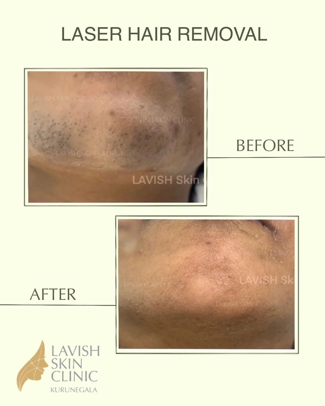 Diode & Nd:YAG Laser Hair Removal laser hair removal care at Lavish Skin Clinic in Kurunegala