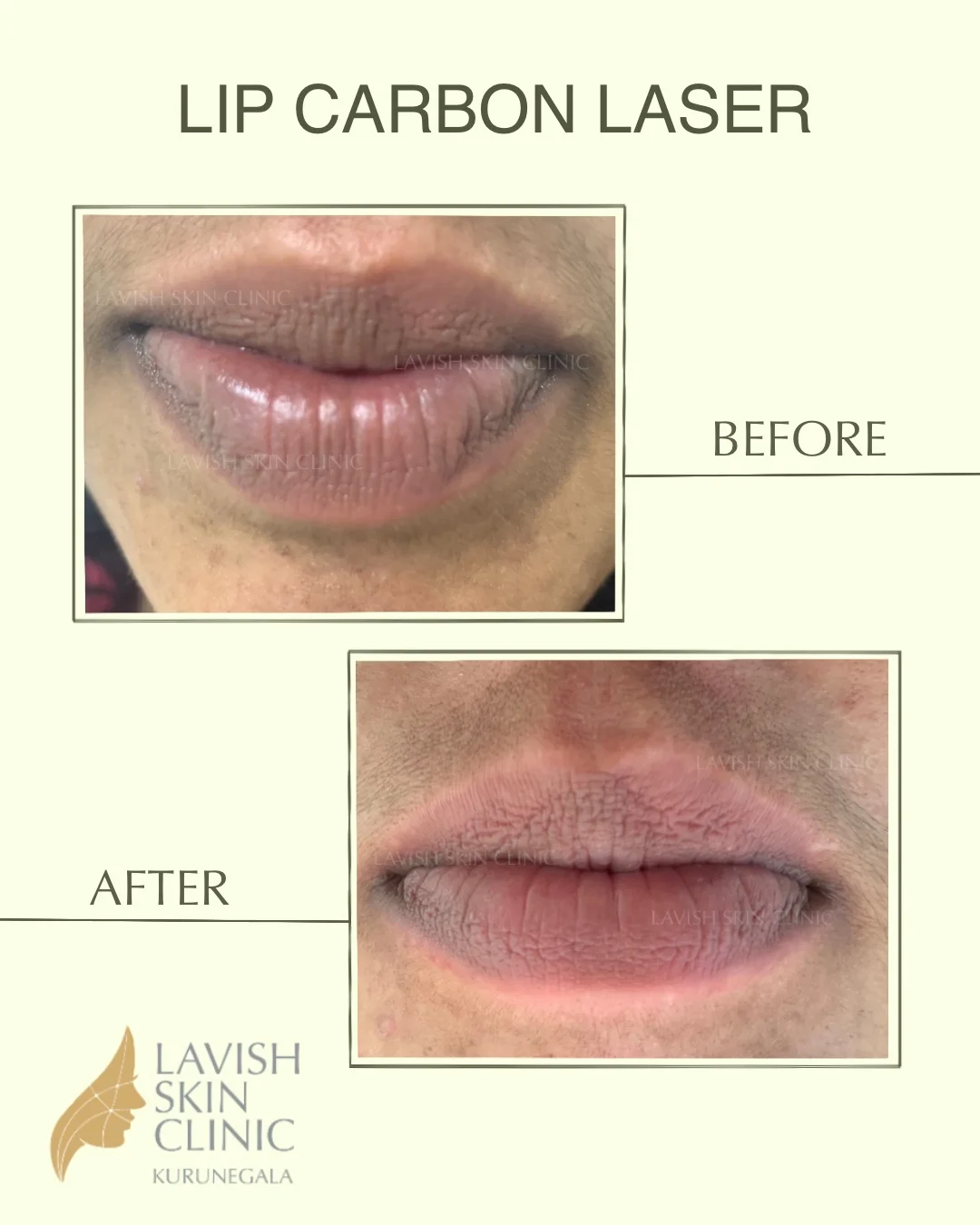 Dark Lips, Birthmarks & Freckles body, scars & removal care at Lavish Skin Clinic in Kurunegala
