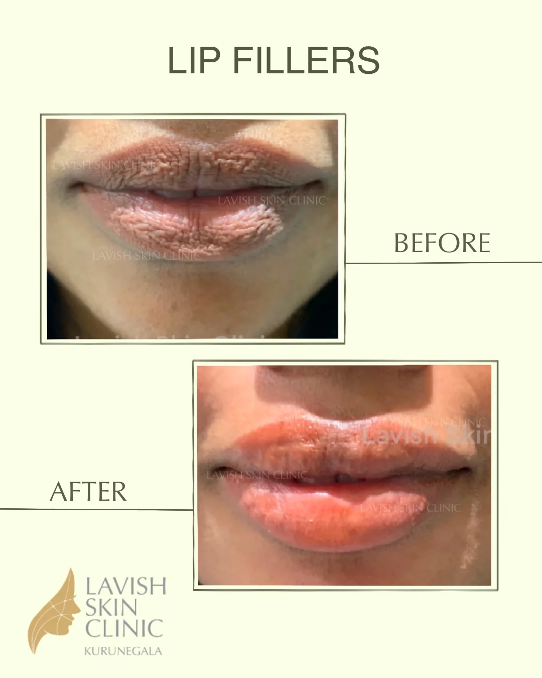 Lip, Chin & Facial Fillers injectables & contouring care at Lavish Skin Clinic in Kurunegala