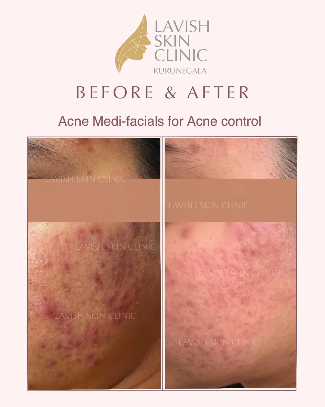 Medical Medi-Facials medi-facials care at Lavish Skin Clinic in Kurunegala