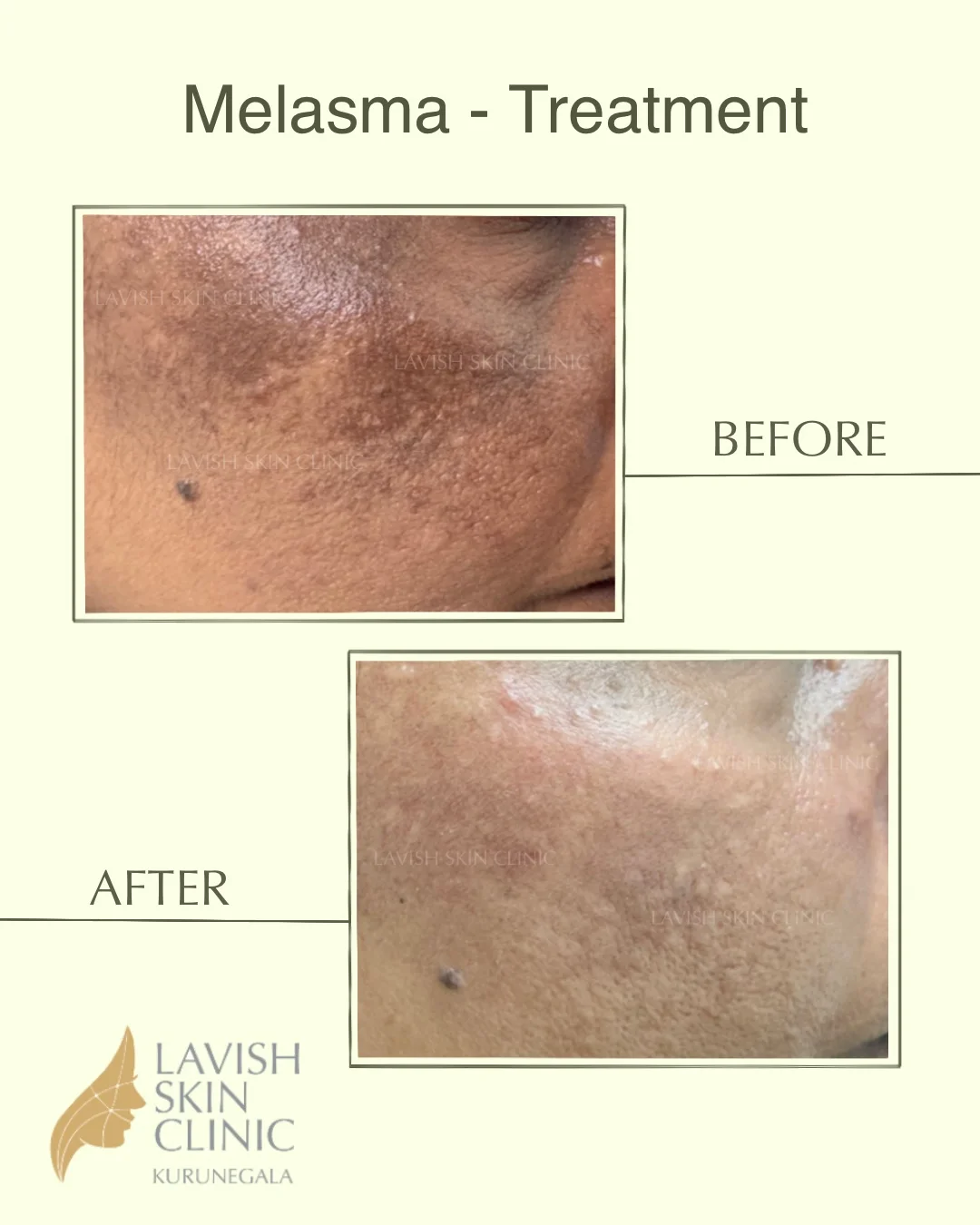 Pigmentation, Melasma & Dark Patches pigmentation & brightening care at Lavish Skin Clinic in Kurunegala