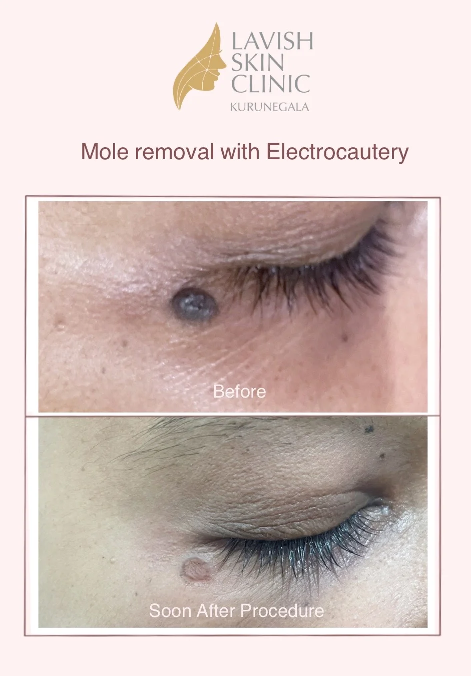 Milia, Wart & Mole Removal body, scars & removal care at Lavish Skin Clinic in Kurunegala