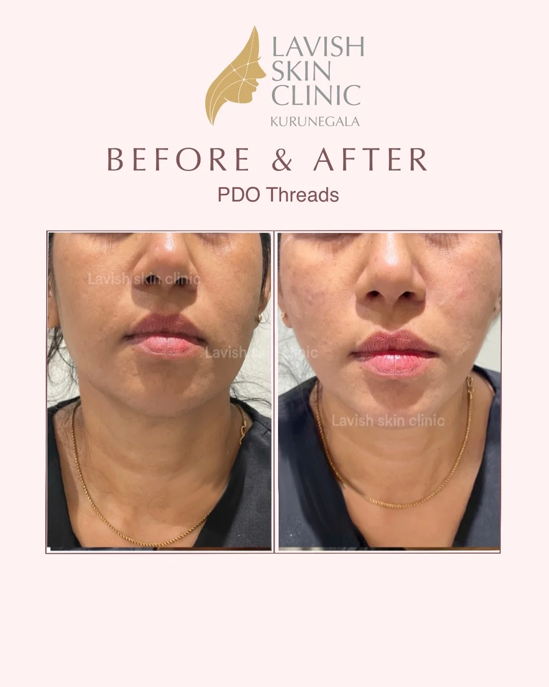 HIFU, Threads & Collagen Induction anti-aging & rejuvenation care at Lavish Skin Clinic in Kurunegala
