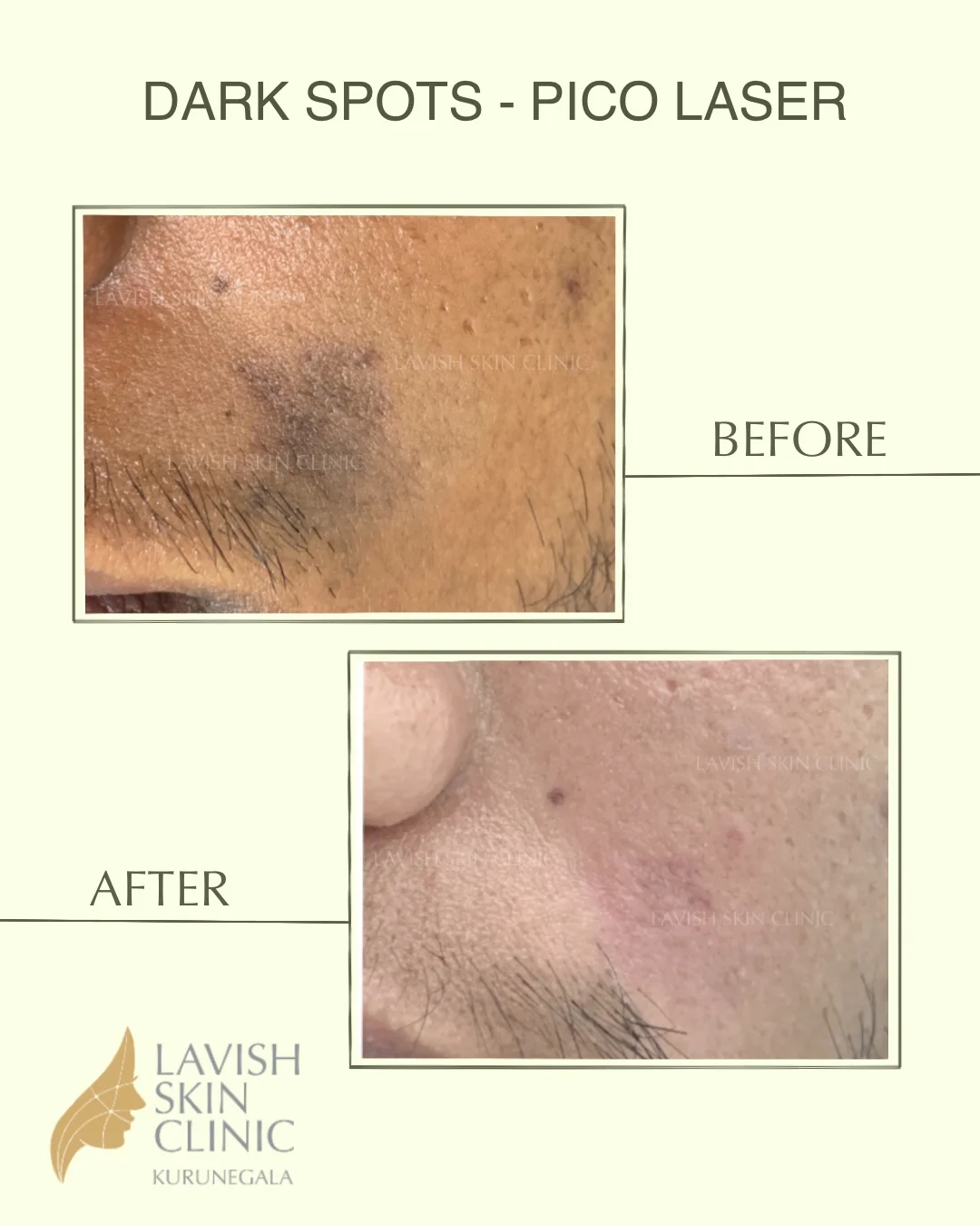 Pico, Q-Switch & Carbon Laser pigmentation & brightening care at Lavish Skin Clinic in Kurunegala