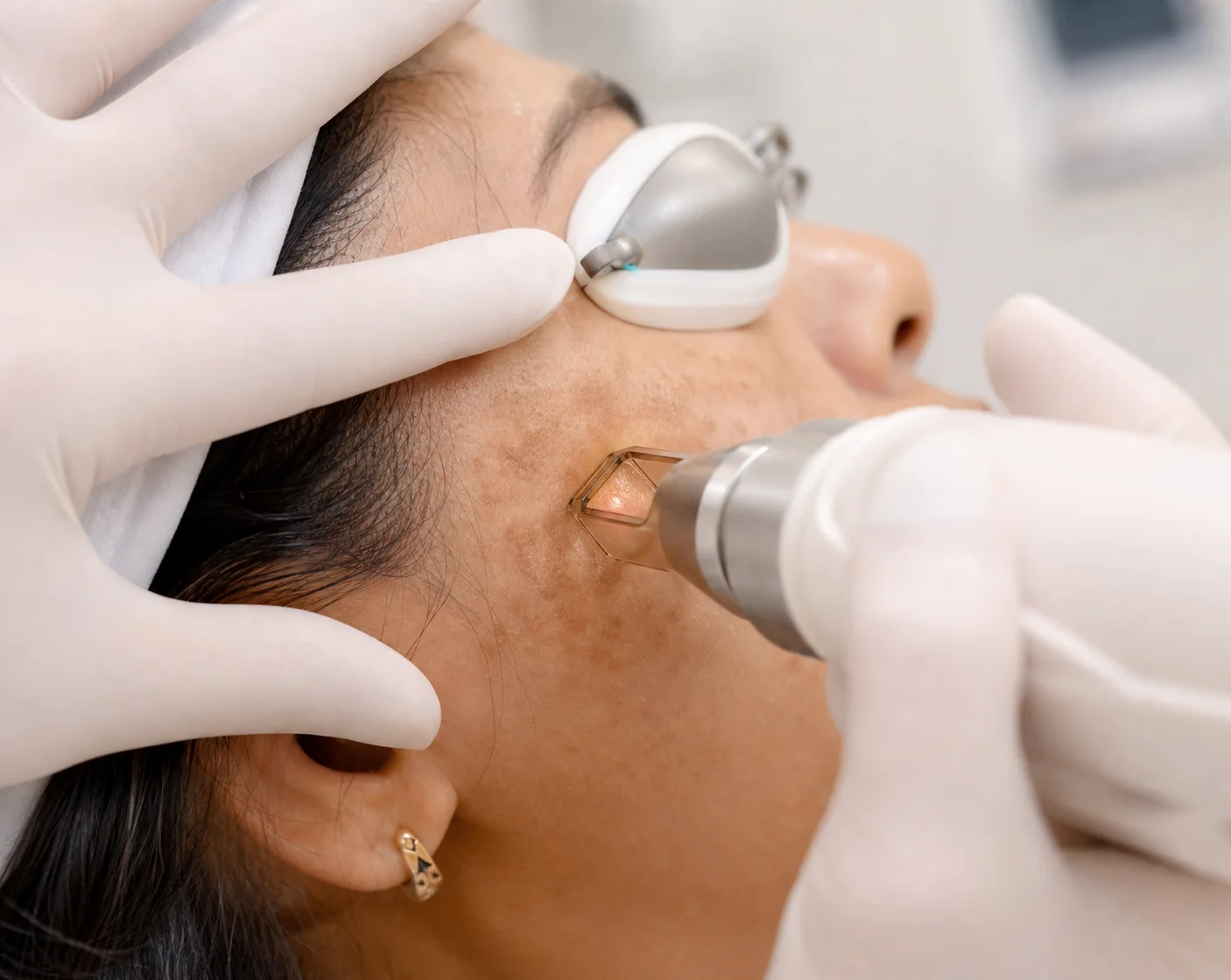Close-up pigmentation laser procedure at Lavish Skin Clinic