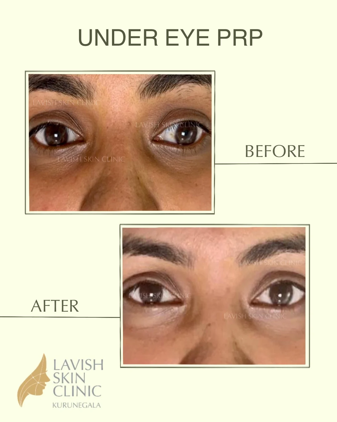 Under-eye PRP & Skin Rejuvenation injectables & contouring care at Lavish Skin Clinic in Kurunegala